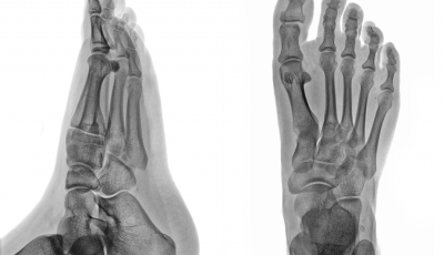 Lesões e patologias nos pés e tornozelos: panorama geral