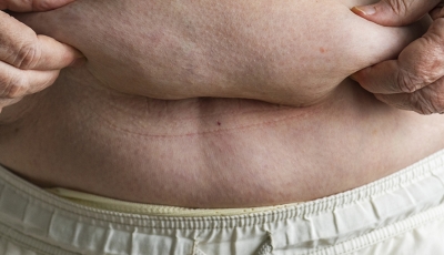 Obesidade: doença pode causar dores fortes nos músculos e articulações